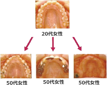 あなたはどの道を選びますか 歯の残存数