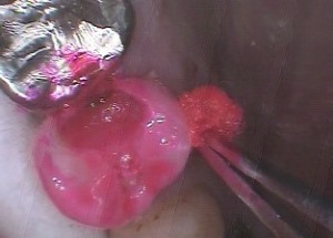 虫歯の染色液で赤く染めます