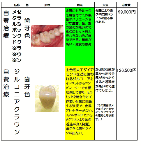かぶせる歯（臼歯の冠）の種類